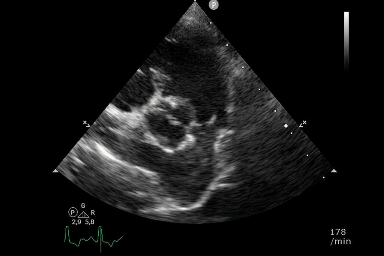 Pulmonalklappenstenose (Ultraschall)