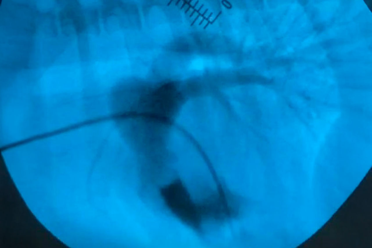 Pulmonalklappenstenose (Angiographie)