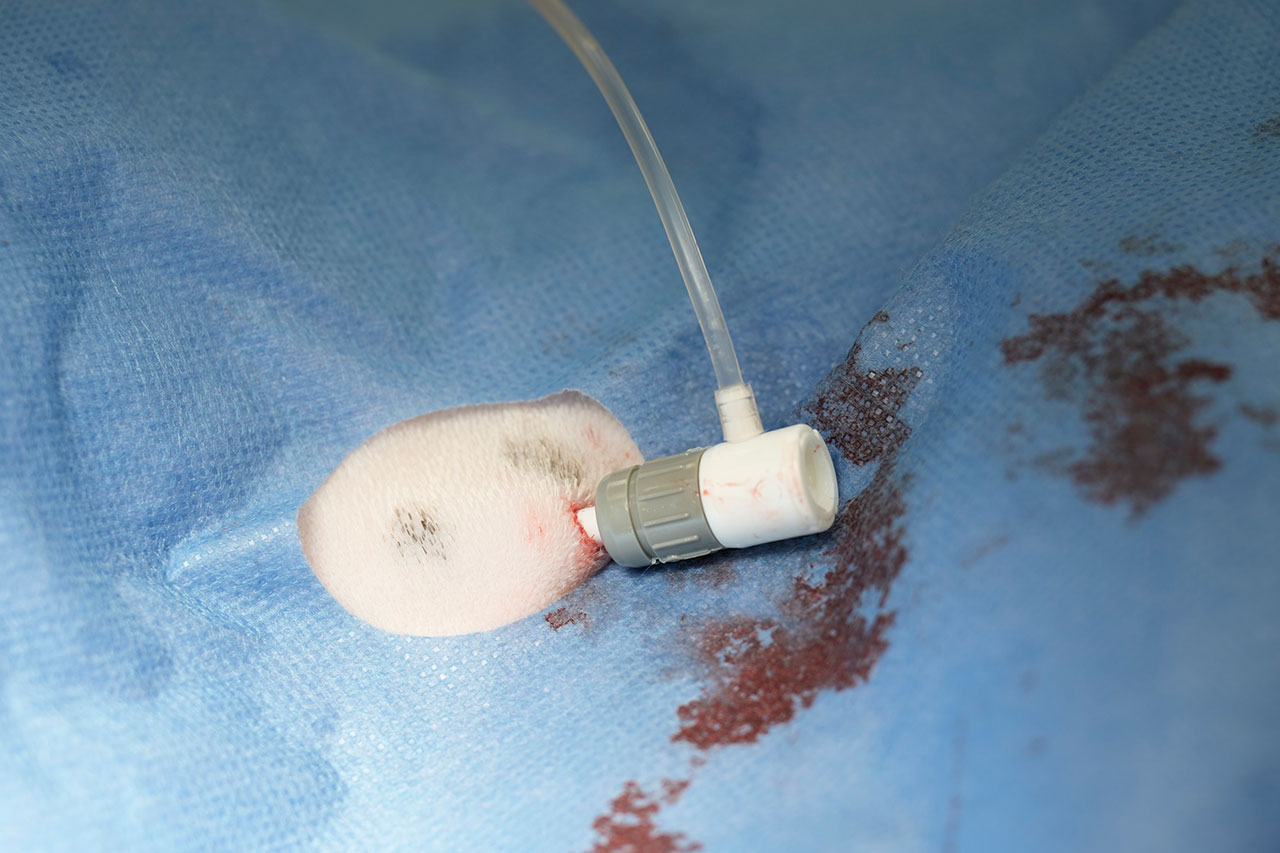 minimal-invasiver Zugang ohne Schnitt