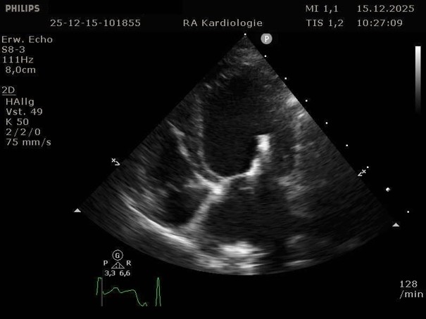 Derselbe ca. fünf Monate nach dem Eingriff. Deutliche Reduktion der linksatrio-ventrikulären Dimensionen, V-Clamp im anatomischen Bereich A2-P2 darstellbar.