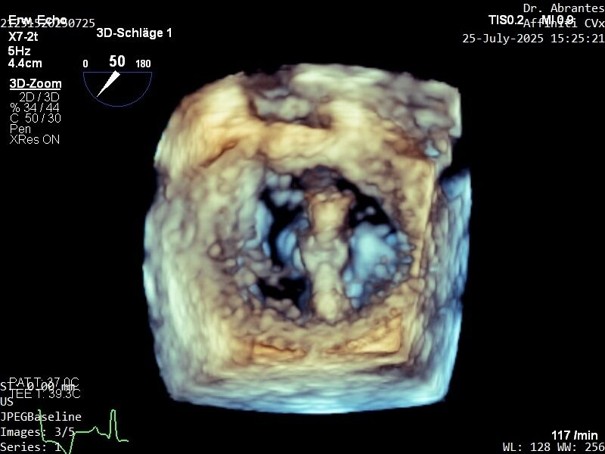 3D-en-face-Darstellung der Mitralklappe (Ansicht vom linken Vorhof auf die Mitralklappe) während des Eingriffs. In dieser Phase erfolgt die Positionierung des V-Clamps (im anatomischen Bereich A2-P2 darstellbar).