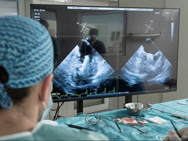 Darstellung des Monitors mit optimierter Visualisierung der intraoperativen Ultraschallbilder zur präzisen Steuerung und Positionierung des V-Clamps während des Eingriffs.