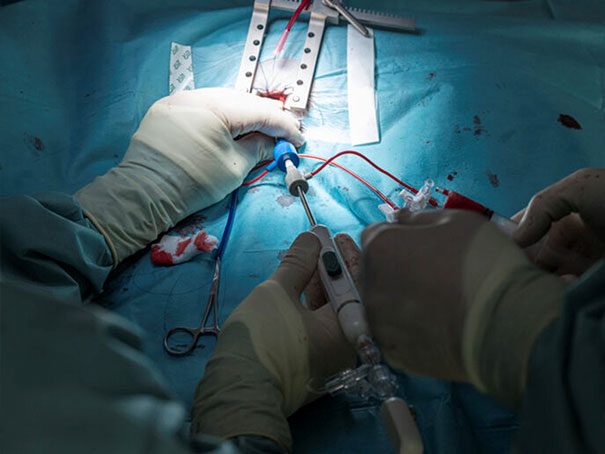 Implantationssystem des V-Clamps im Katheter während des Eingriffs. Sichtbar sind die Thorakotomie sowie die Hände des Operateurs während der kontrollierten Einführung und Positionierung des Systems.